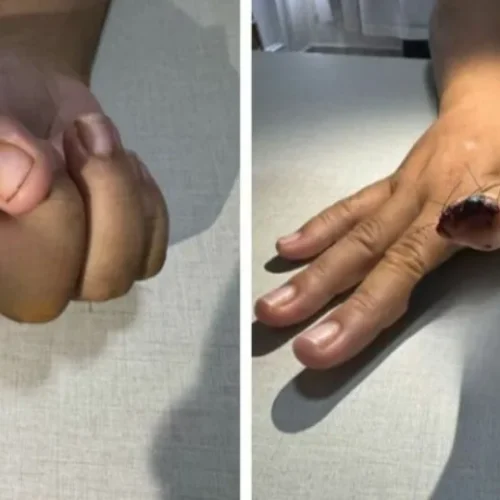 Homem arranca dedo da namorada com mordida em ataque por ciúmes