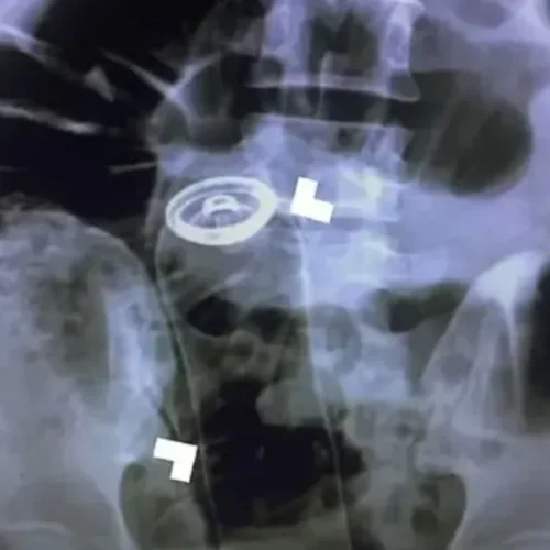 Homem é hospitalizado ao “perder” frasco de desodorante no reto, em Porto Velho