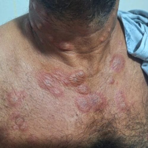 Governo de RO reforça campanha de conscientização sobre hanseníase na reta final do Janeiro Roxo