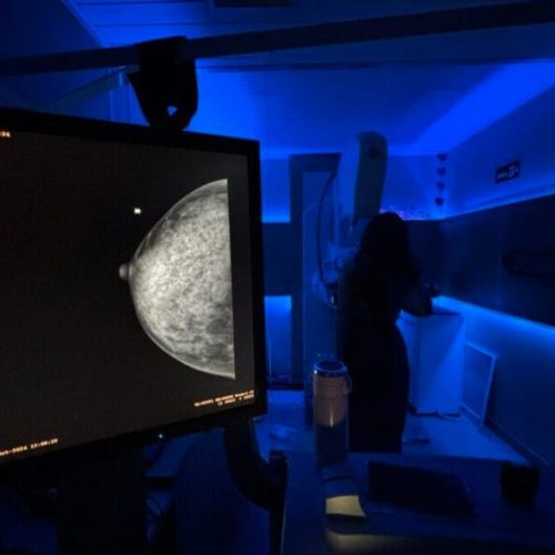 Governo de RO fortalece atendimento à saúde das mulheres com câncer por meio da reconstrução mamária