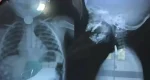 Menino de dois anos morre após engolir moeda em distrito de Calama