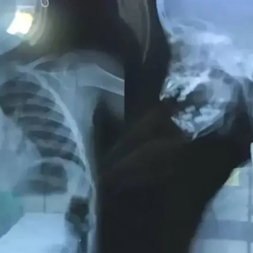 Menino de dois anos morre após engolir moeda em distrito de Calama